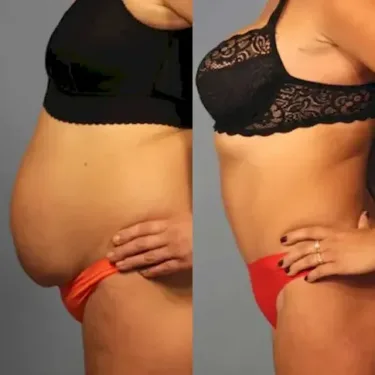 Abdominoplastie