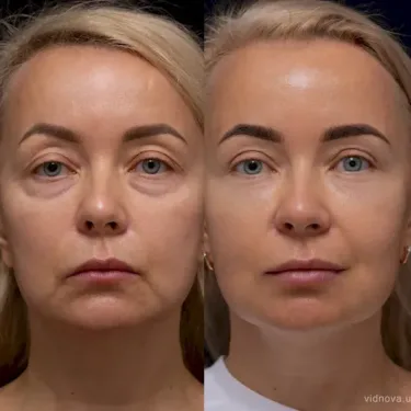 Blépharoplastie