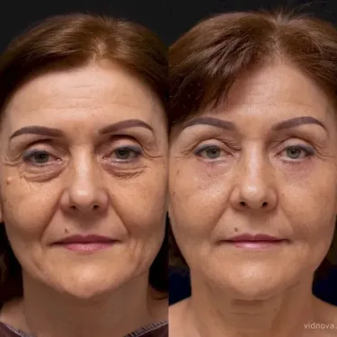 Blépharoplastie