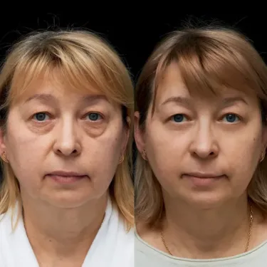Blépharoplastie