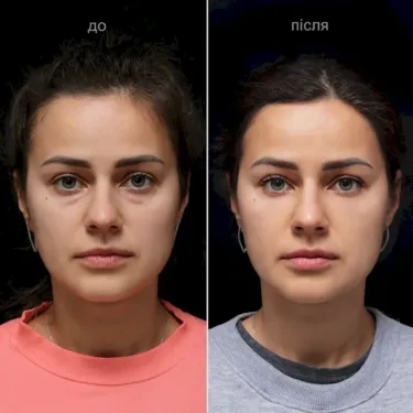 Blépharoplastie