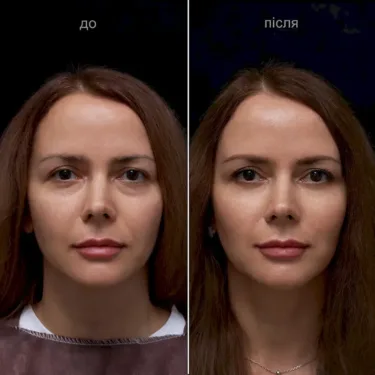 Blépharoplastie