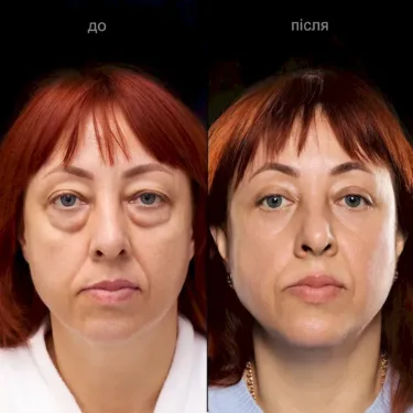 Blépharoplastie
