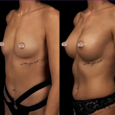 Augmentation mammaire