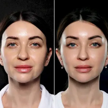 Lifting du visage