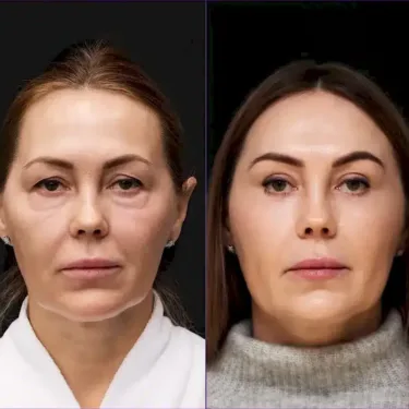 Lifting du visage
