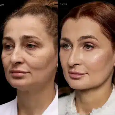 Lifting du visage