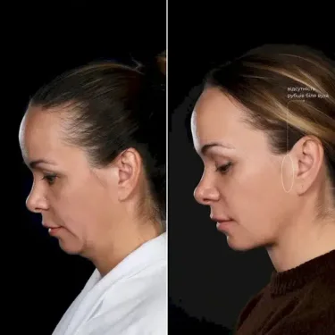 Lifting du visage