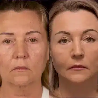 Lifting du visage