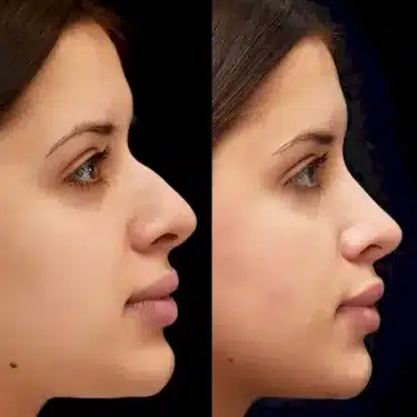 Rhinoplastie