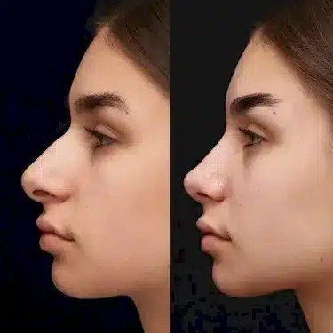 Rhinoplastie