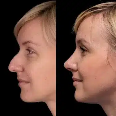 Rhinoplastie