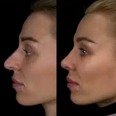 Rhinoplastie