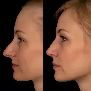 Rhinoplastie