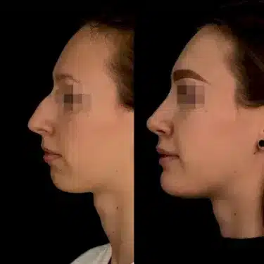 Rhinoplastie