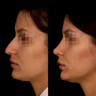 Rhinoplastie