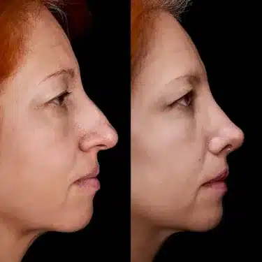Rhinoplastie