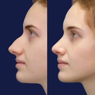 Rhinoplastie