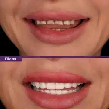 Dentisterie esthétique