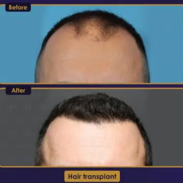 Hair transplant