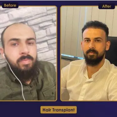 Hair transplant