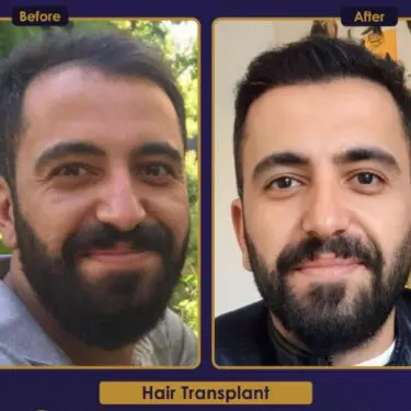 Hair transplant
