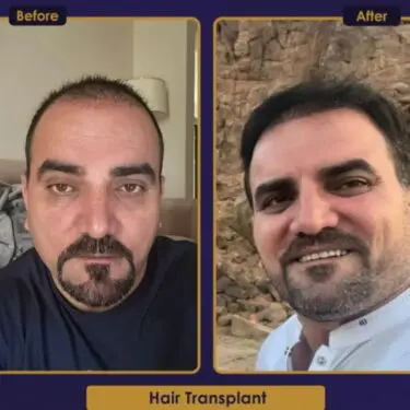 Hair transplant