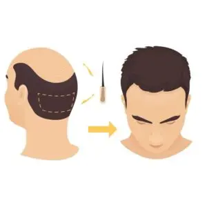 dhi vs fue which is better