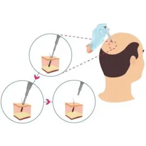 fue vs dhi hair transplant