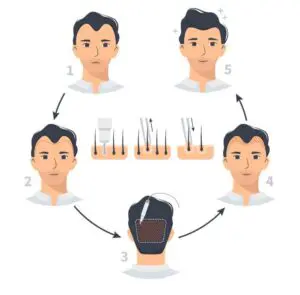 fue vs dhi hair transplant