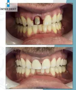 dentistry in turkey