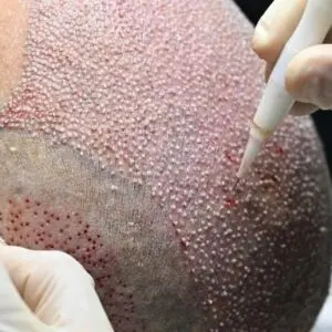 Сколько стоит пересадка волос в Турции