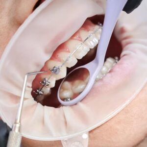 турецька стоматологія