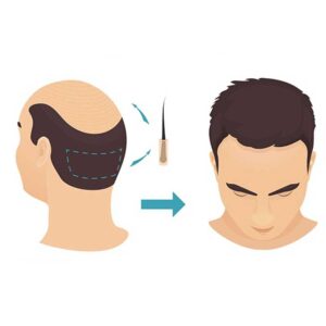 What is a FUE hair transplant