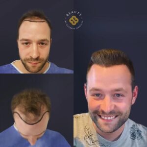 Hair transplant after the procedure