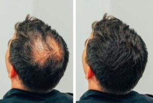 пересадка волос до и после в Турции