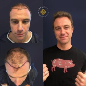трансплантація волосся в Туреччині до і після