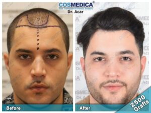 Пересадка волос до и после в Турции