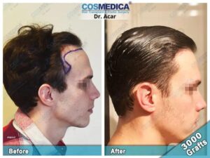 Hair Transplantation Before and After in Turkey