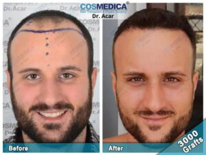 Hair transplant results in Turkey