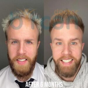 Пересадка волосся до і після в Туреччині