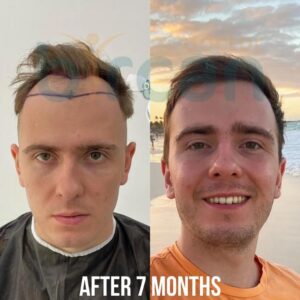 Трансплантація волосся до і після в Туреччині