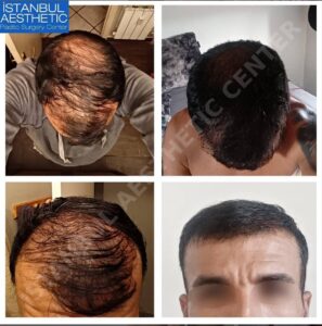 Трансплантація волосся в Туреччині до і після