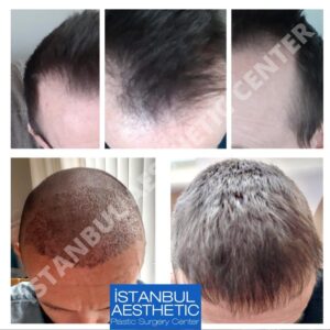 Hair transplant in Turkey before and after