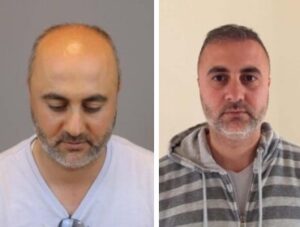 Трансплантация волос до и после в Турции