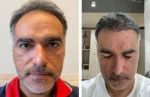 Результаты пересадки волос до и после в Турции