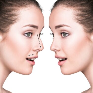 Septoplasty and rhinoplasty: what are the differences, can two operations be done at the same time?