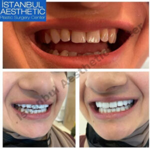 Dental implantation in Turkey