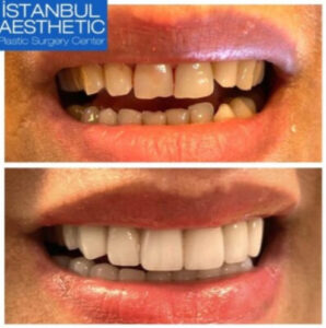 Dental implantation before and after