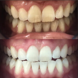  Teeth whitening before and after